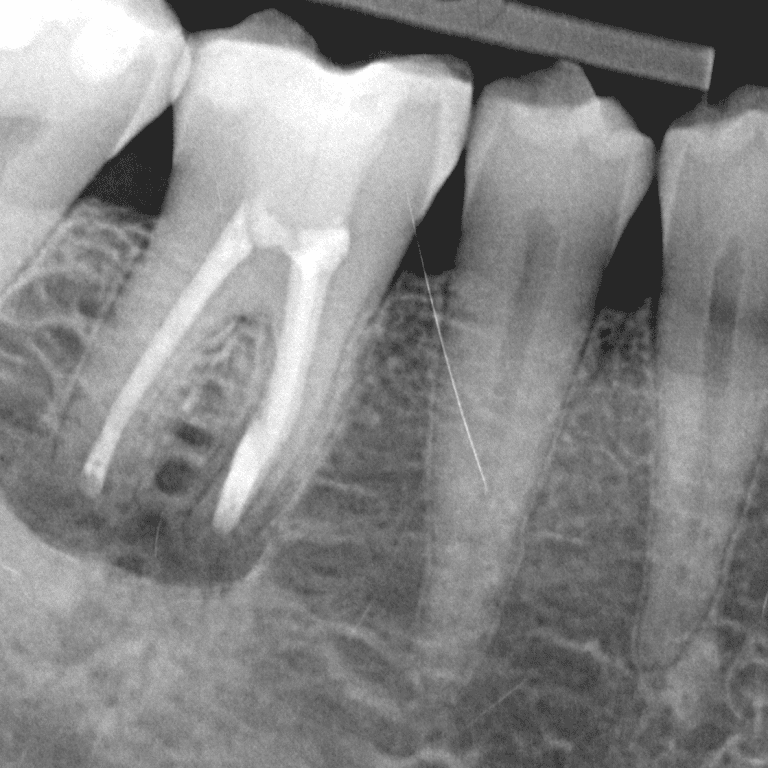Tand gør ondt rodbehandlet Betændelse i