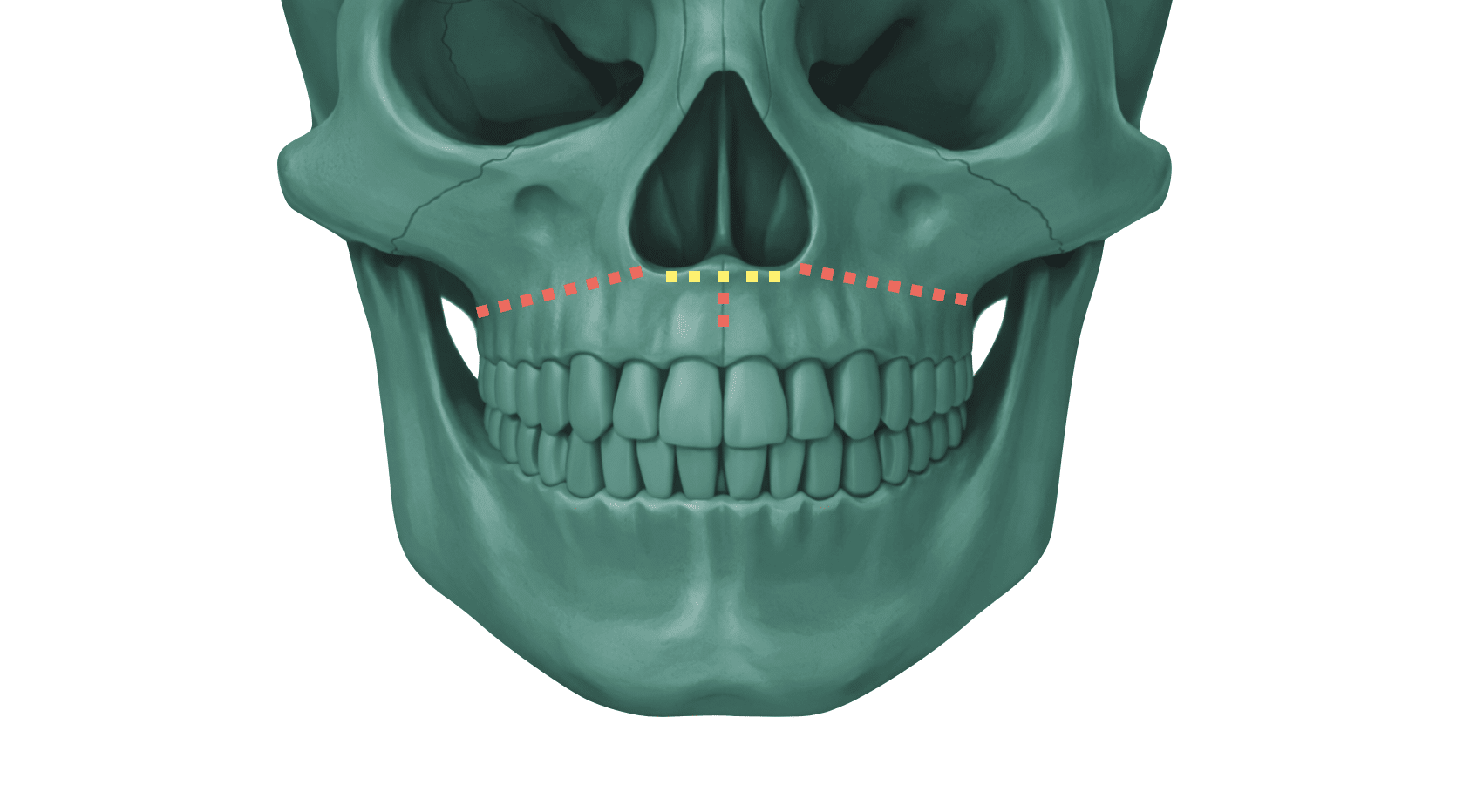 Kombineret ortodonti og kirurgi - Minimally invasive surgical and miniscrew-assisted rapid palatal