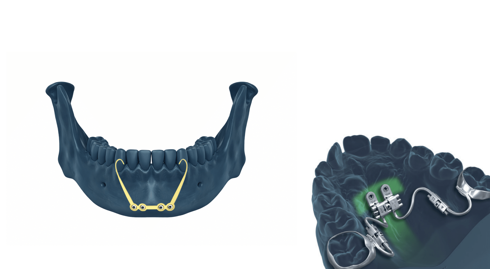 Kombineret ortodonti og kirurgi