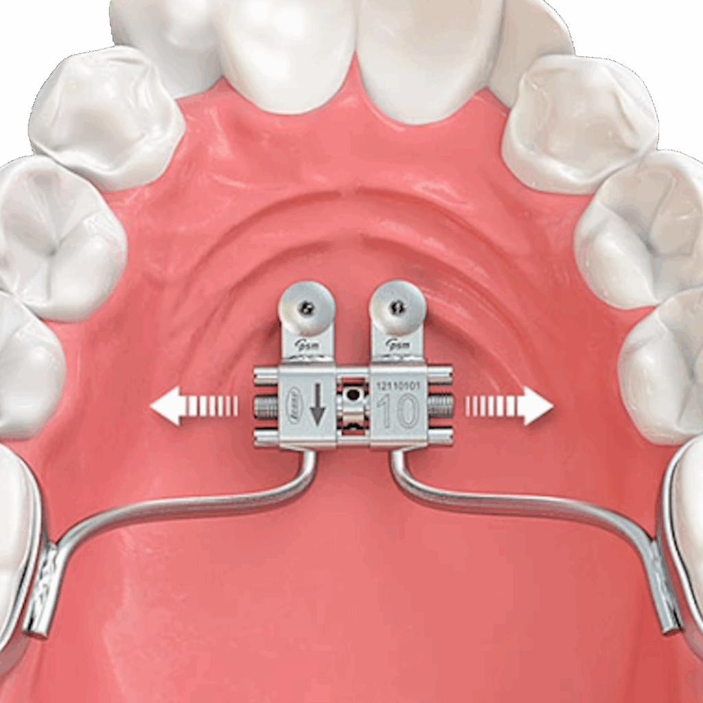 Rapid palatal expansion