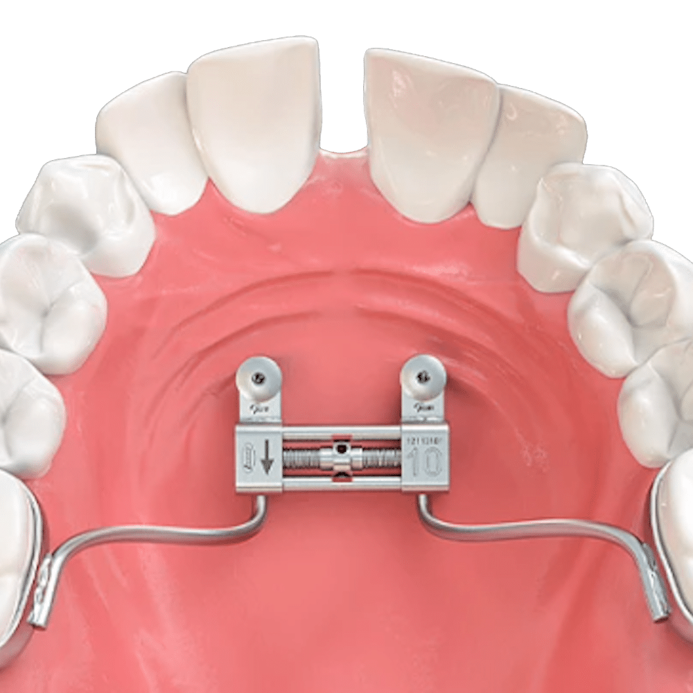 Effect of rapid palatal expansion