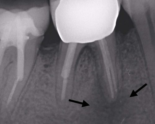 kindtand med rodspidsbetændelse
